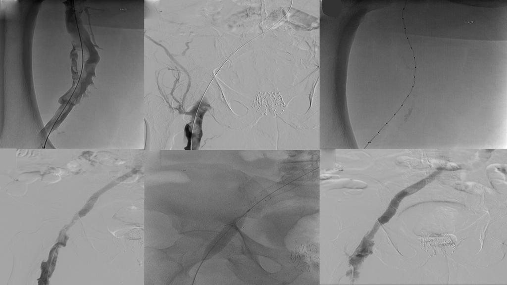 Multiple bilateral venous collaterals are present; (B) fluoroscopic image of the pelvis demonstrates recanalization of the chronic occlusions of the bilateral iliac veins and infrarenal IVC.