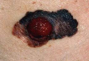 DO YOU NEED DERMOSCOPY FOR EVERY PIGMENTED LESION? Of course not!