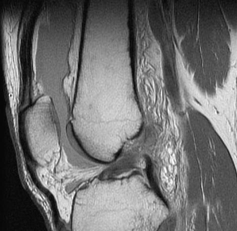 FIGURE 3: Sagittal view of the knee demonstrates an ACL tear with