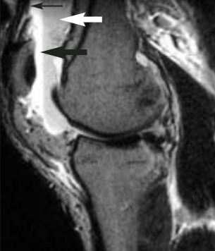 facet (small arrow), ie. the points of contact at the time of dislocation.  6: Lipohemarthrosis. A three-layer lipohemarthrosis is seen on T2-weighted image.