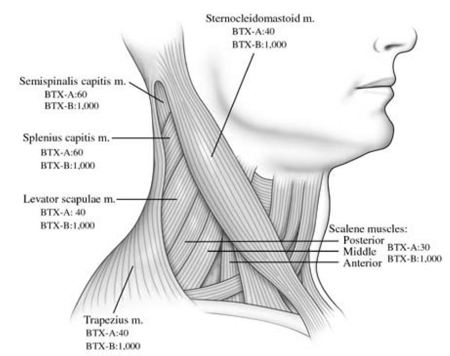Cervical Dystonia: : Which muscles to inject?