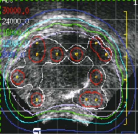 while maintaining safe distances of the seeds from the rectum. 12.9.4 Treatment Planning During treatment planning, the prostate capsule as visualized on the TRUS images is segmented as the GTV.
