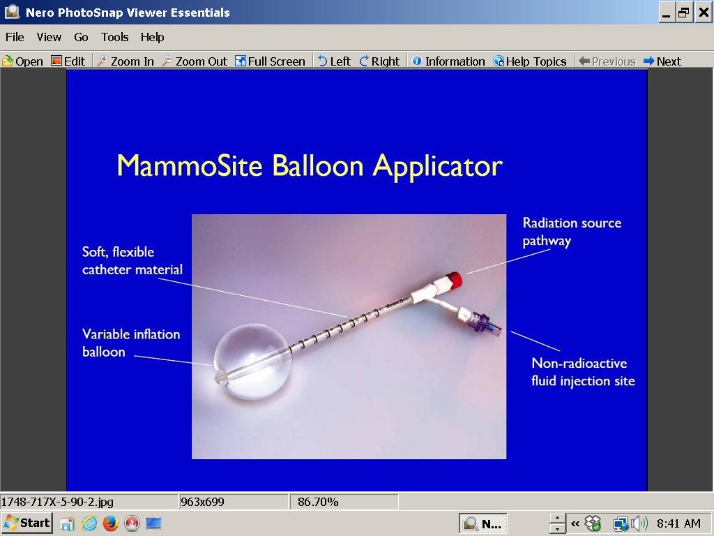 Applicator method: MammoSite There are two types: a single lumen
