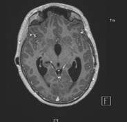 lateral ventricle MRI + / PET - E Right frontal