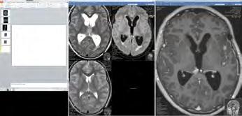 (E) right frontal lobe and (F) left Sylvian
