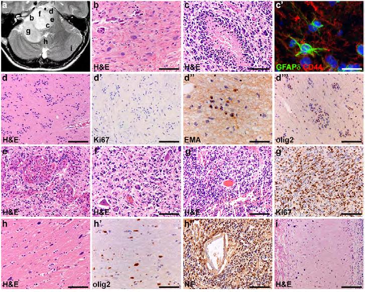 Morphologic and epigenetic heterogeneity in DIPG 5 FIGURE 1 Intratumoral heterogeneity of DIPG (patient VUMC-DIPG-6). (A) axial T2-weighted MR-image; letters correspond to tumor areas illustrated.