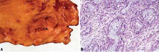 Fig. 2.05 Adenocarcinoma of the proximal stomach ( pylorocardiac type ). A Macroscopic appearance resembles other adenocarcinmomas.