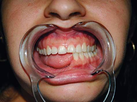 None of the patients complained about pain or limitation of mouth opening at the end of 14.8 months of mean follow-up, varying between 6 and 20 months.