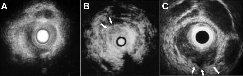 S80 INUI ET AL CLINICAL GASTROENTEROLOGY AND HEPATOLOGY Vol. 7, No. 11S Figure 1. (A) IDUS shows regular thickening of the bile duct wall in a patient with benign stricture.