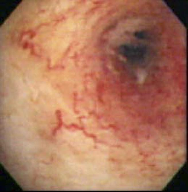 November 2009 DIAGNOSIS AND TREATMENT OF BILIARY STRICTURES S81 without prominent vessels. The light uniform color of the mucosa shown by NBI allowed tumor vessels to be sharply highlighted.