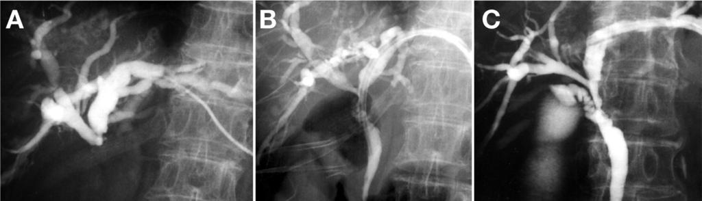 S82 INUI ET AL CLINICAL GASTROENTEROLOGY AND HEPATOLOGY Vol. 7, No. 11S Figure 6. (A) A cholangiogram performed via PTBD of sinus tract depicted obstruction of the proximal extrahepatic bile duct.