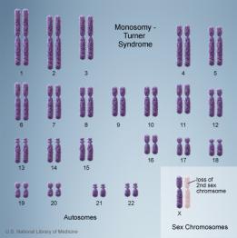 Monosomic zygote has only one copy of a par:cular chromosome Trisomic zygote has three copies of a