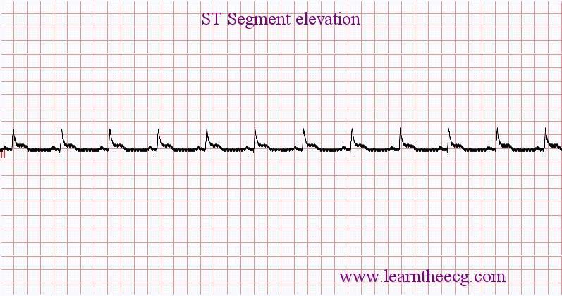 ST segment elevation -represents tissue injury due to acute, prolonged reduction in BF.