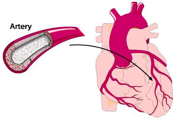 Myocardial infarction: heart attack -occurs