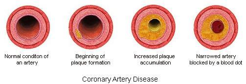 The Causes of Coronary Artery Disease Poor Diet, Smoking, Elevated blood lipids,