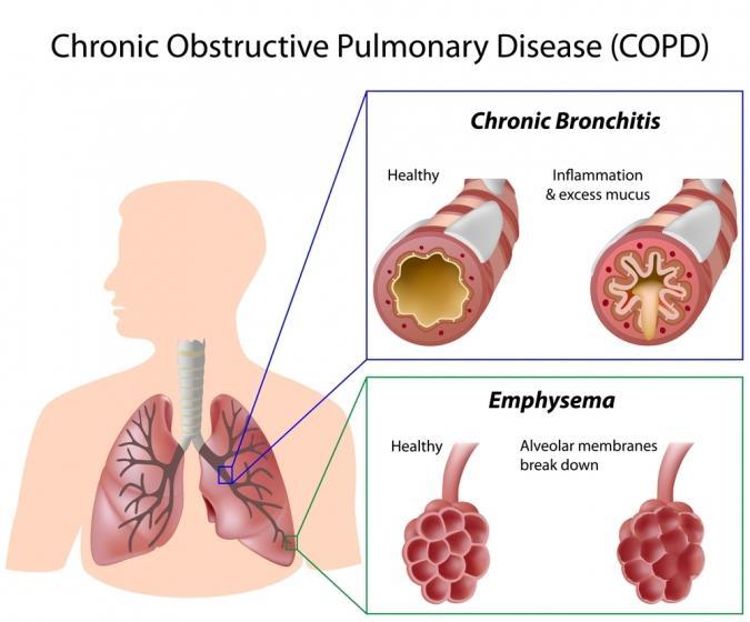 Respiratory Diseases Chronic obstructive pulmonary disease (COPD) is a general term that describes a family of diseases that lead to a dramatic reduction in airflow through the respiratory system.