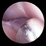 cartilage integrity in the lateral