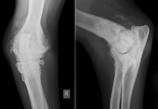 Case Selection Exclusion: end-stage OA medial & lateral