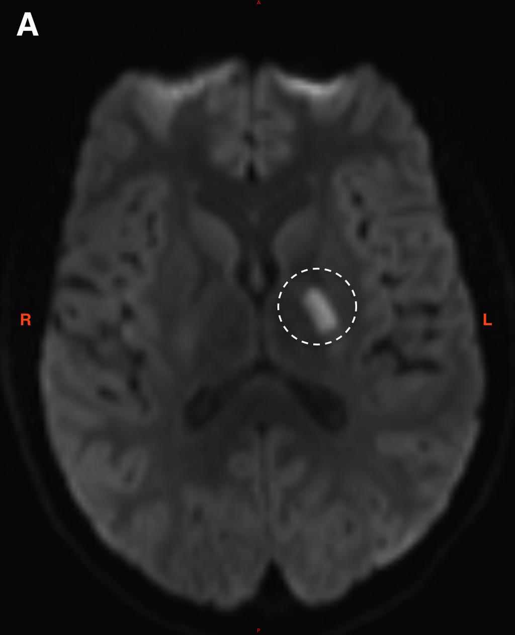 Case 2 This is an 18 year old male with persistent right hand weakness, four years following a left MCA territory ischemic stroke (Fig 3A), underwent an quantitative MTR image