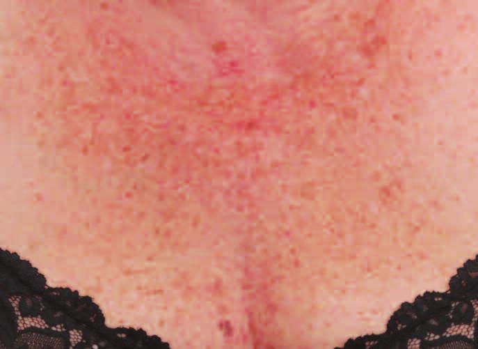 One month after 3 treatment with EndyMed PRO fractional RF skin resurfacing showing a