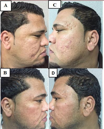 Demographic data: The present study included 20 patients with different types of atrophic post acne scars (10 moderate and 10 severe) based on Goodman & Baron s qualitative classification.