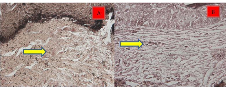Comparison between type III collagen content using silver stain before treatment and 1 month after the last fr.co2 session at the side treated with combined PE technique and fr.