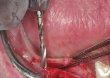 29 Adequate bone quantity for implant placement without the need for grafting Adequate keratinized soft tissue in the edentulous area for