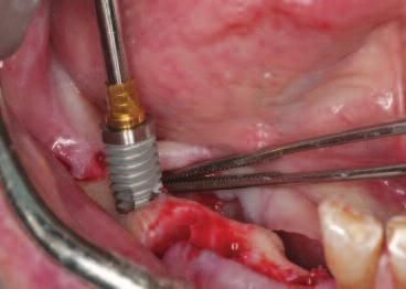 advanced to the first laser line (for crestal placement) to shape the coronal aspect of the implant site. The drill was used at 1200rpm.