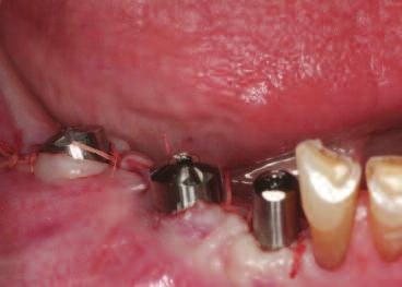A 5mm diameter NanoTite Certain Implant was picked up from the sterile package using a Certain Implant Placement Driver Tip (IIPDTS).