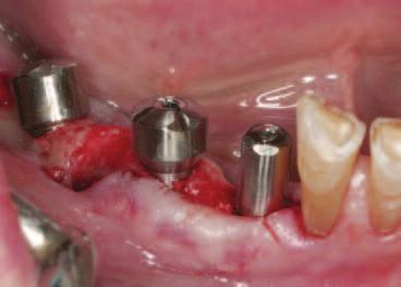Following the recommended protocol for placement of NanoTite Implants, irrigation was not used during implant placement allowing the blood to contact the implant surface and thus, maximizing fibrin