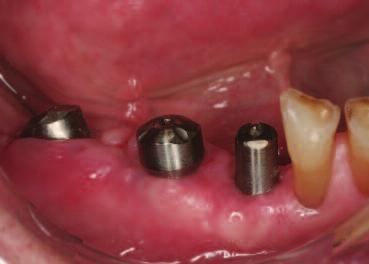 tip and the internal interface of the implant.