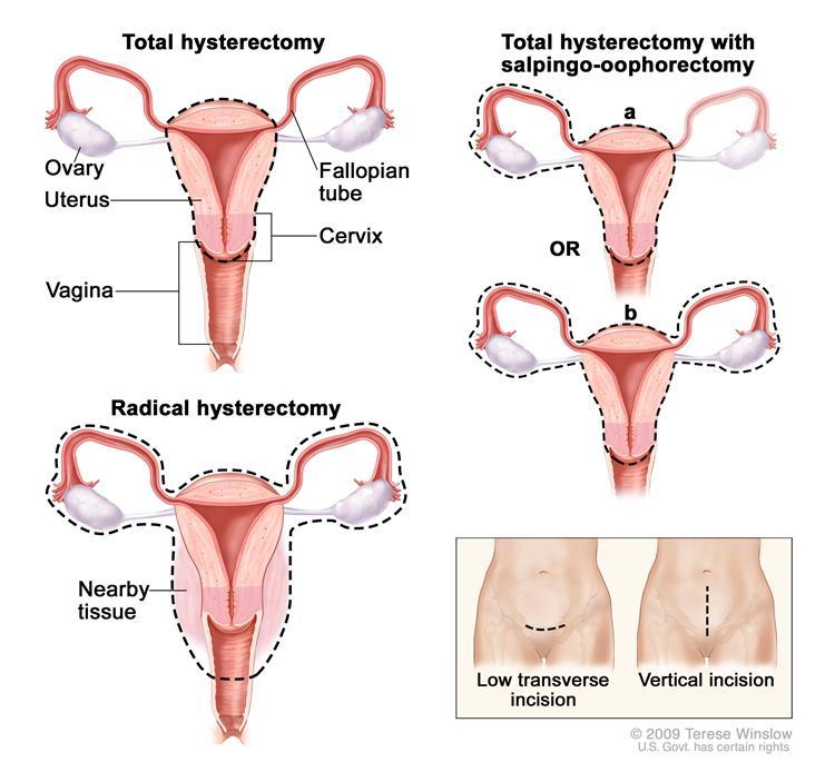 Hysterectomy*. The uterus is surgically removed with or without other organs or tissues. In a total hysterectomy*, the uterus and cervix are removed.