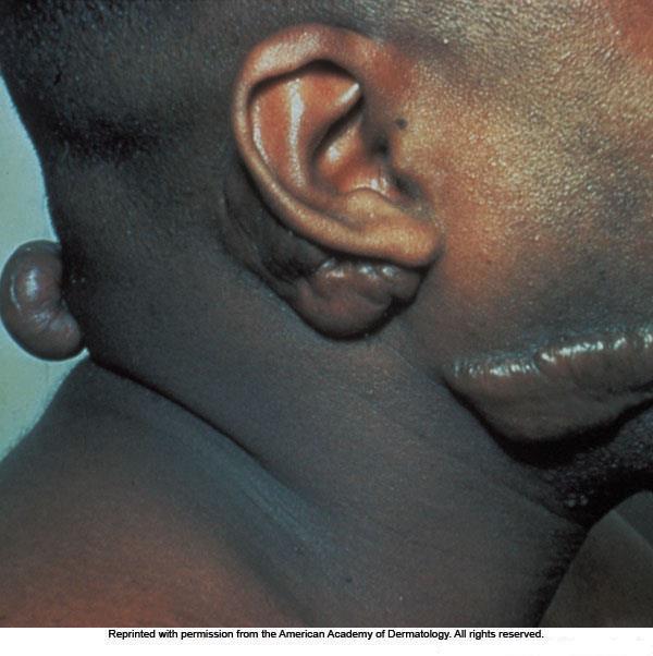 Secondary Lesions (continued) Keloid thick scar Scale thin plate of epidermal flakes