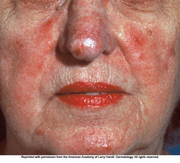 Sebaceous Gland Disorders (continued) Sebaceous cyst large, protruding, pocketlike lesion filled with sebum