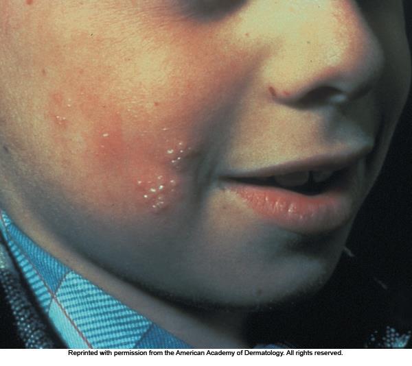 Skin Inflammations (continued) Herpes