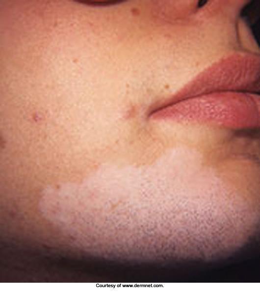 Tan caused by exposure to UV rays Vitiligo