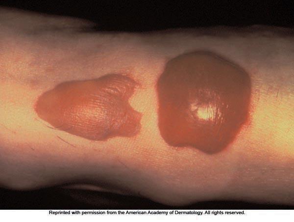 Primary Lesions Bulla blister Cyst sac containing fluid pus Macule small,