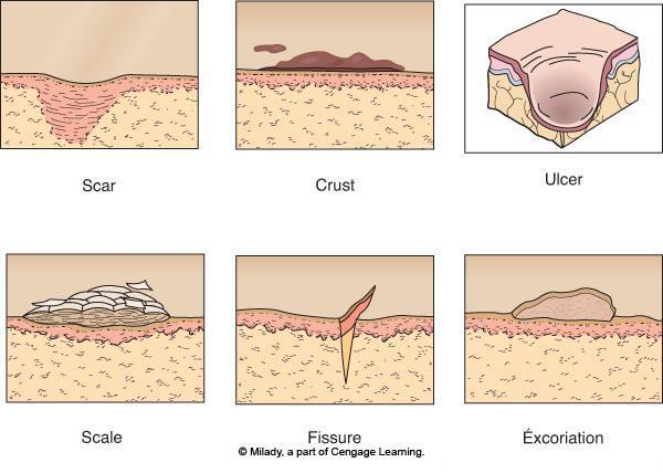 Secondary Lesions Crust dead cells formed over a wound or