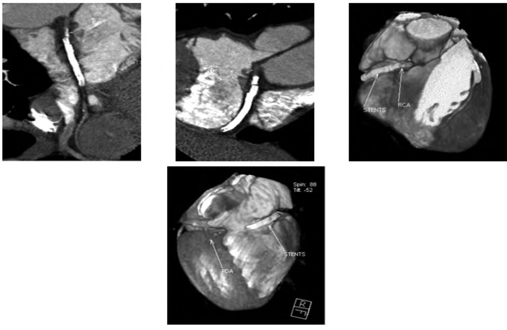 Sherif M. Maher, et al. 399 Case (5): Male pt 55yrs old is known to have an ischemic heart disease.