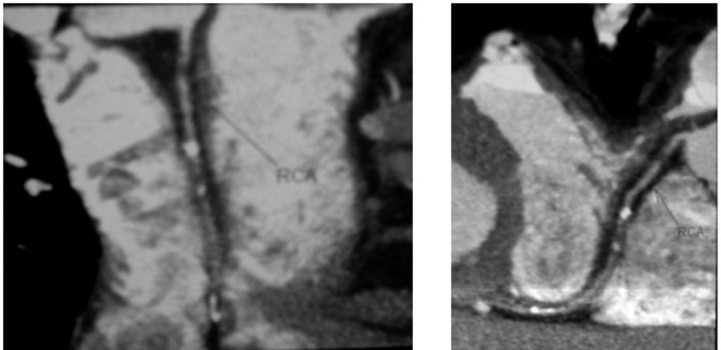 396 Detection of Coronary Artery Stenoses Case (2): Male patient 52 years old, known to be diabetic and hypertensive, presented for the last one month by intermittent attacks of staggering