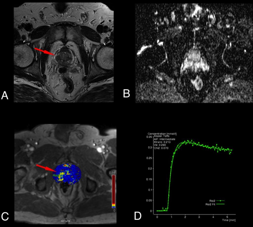 (A), with strong contrast uptake in the arterial phase of the dynamic T1-weighted scan (B) and restricted