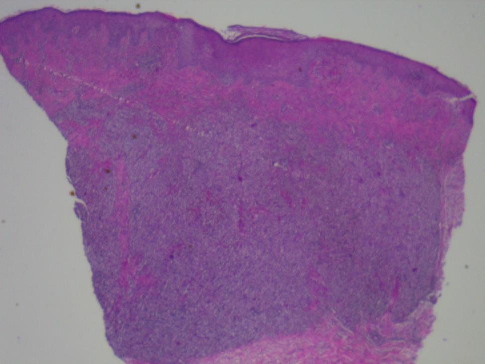 Tumorous nodule with melanin