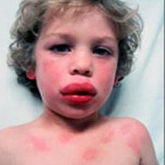 Symptoms of Anaphylaxis Tingling lips, mouth or tongue Tightening of