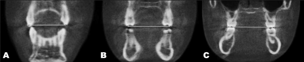 in millimeters), AgL-AgR (mandibular width in millimeters).