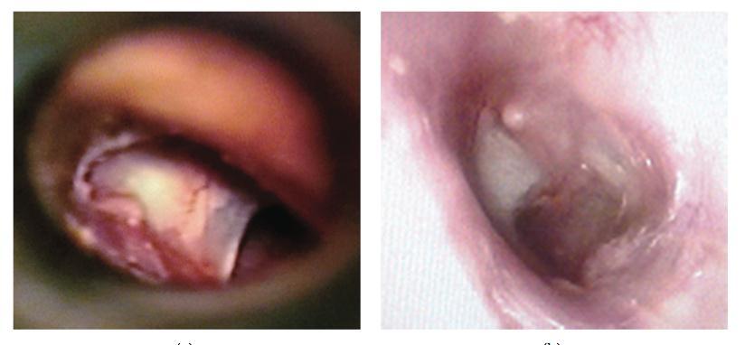 PRP in Tympanic Membrane Perforations Evidence in