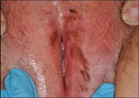 Vulvar Disease Clinical Cases Hope K.