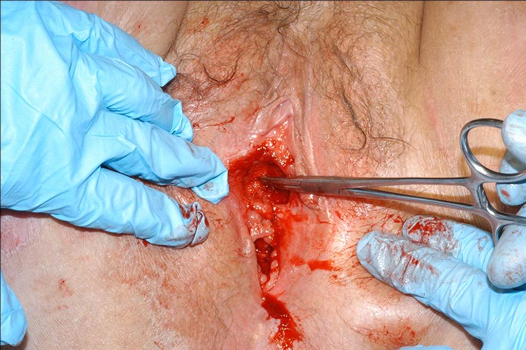 After exam under anesthesia, visible pubic ramus. What Do You Suggest be Done NOW? A. D and C only B.