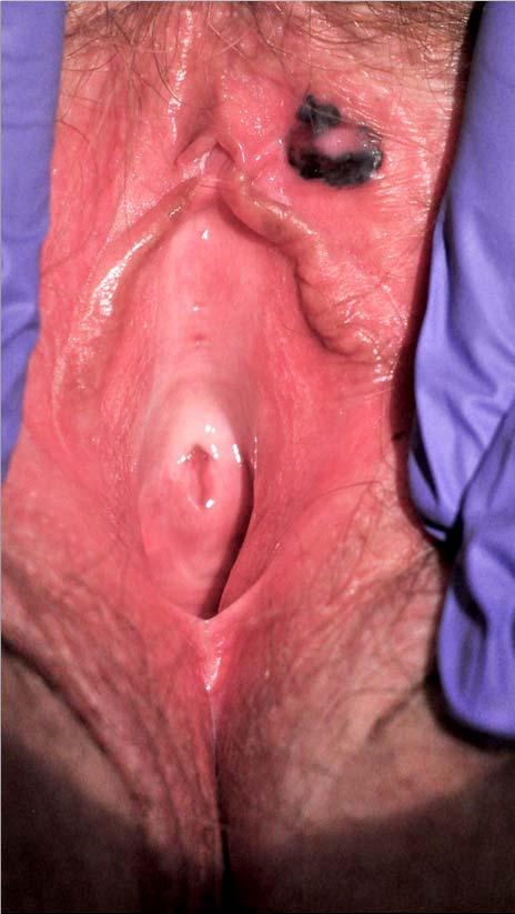 Malignant Melanoma and Lichen Sclerosus Vulvar Malignant Melanoma ( MM