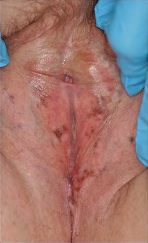 Vulvar Melanosis Common Pigmented macules and patches Solitary or multifocal Angular and asymmetrical Usually vulvar trigone Dx - biopsy Melanosis and LS A 64