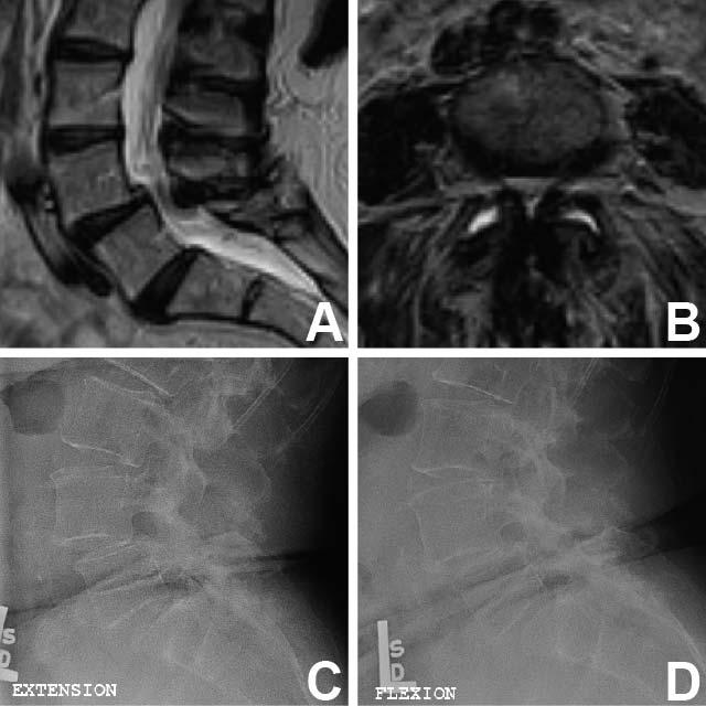 Minimally Invasive Laminectomy in Spondylolisthetic Lumbar Stenosis Figure 1. Typical imaging findings in the patients included in our series.